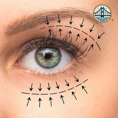 Blefaroplastia