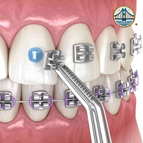 Brackets dentales en Albania