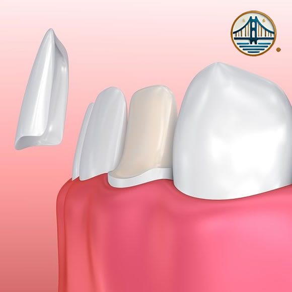 Carillas dentales
