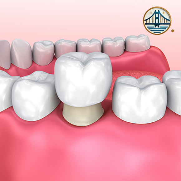 Coronas de Zirconio en Albania