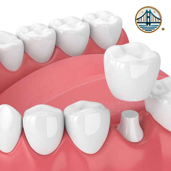 Coronas de Zirconio