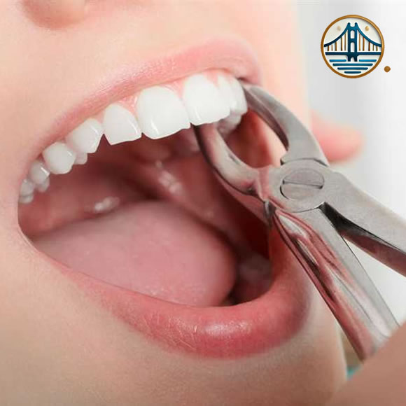 Extracción dental