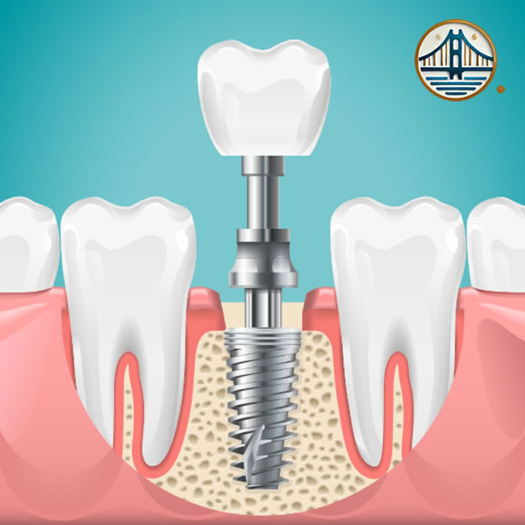 Implante dental único