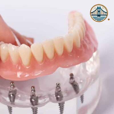 Implantes All-on-Four en Albania Implantes All-on-Four en Albania