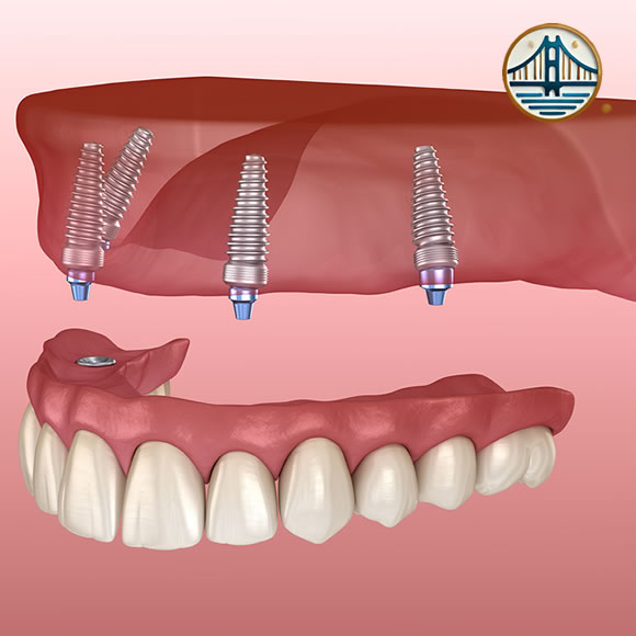 Implantes All-on-Four