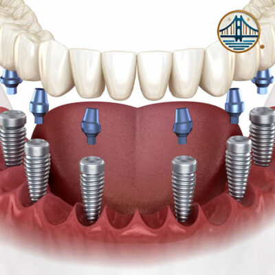 Implantes All-on-Six en Albania Implantes All-on-Six en Albania