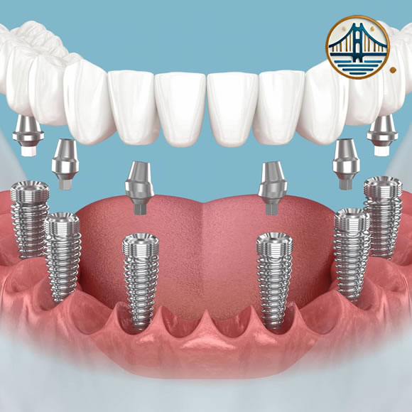 Implantes All-on-Six