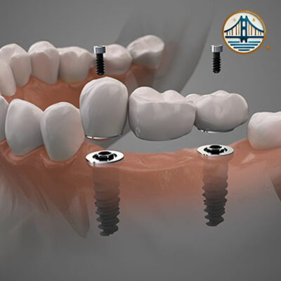 Puente soportado por implantes en Albania