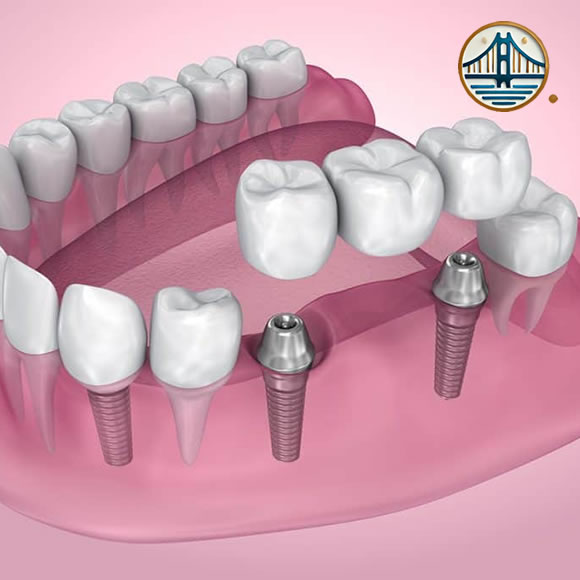 Puente soportado por implantes