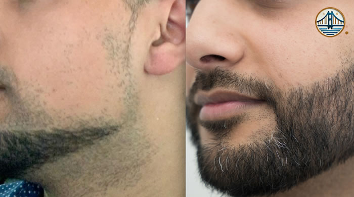 Trasplante de barba