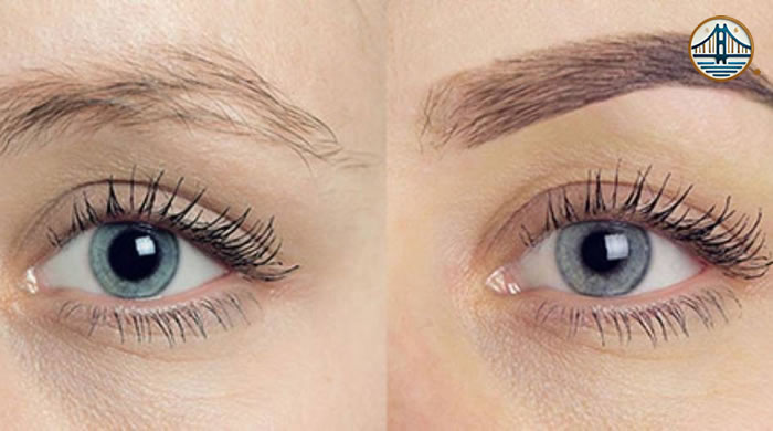 Trasplante de cejas